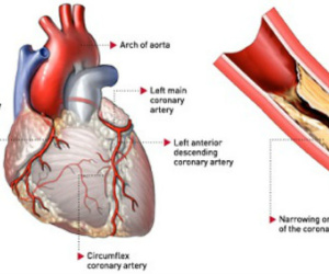 Thủ phạm gây nhồi máu cơ tim