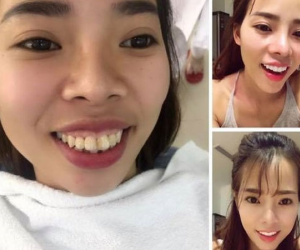 Cô gái Hà Nội chi 200 triệu "đập đi làm lại" toàn bộ gương mặt