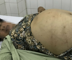 Người phụ nữ mang khối u buồng trứng gần 20 kg