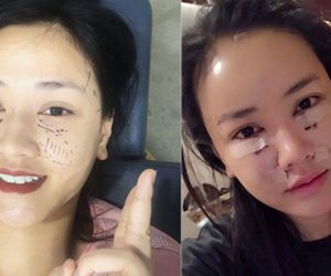 Maya bất ngờ lộ ảnh mặt sưng phù khi đi thẩm mỹ ở Hàn Quốc