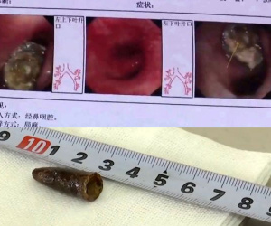 Tìm thấy nắp bút biến dạng kẹt trong phổi gần hai thế kỷ