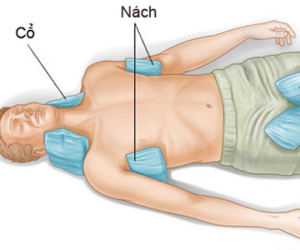 Xử trí khi có người say nắng ngất xỉu