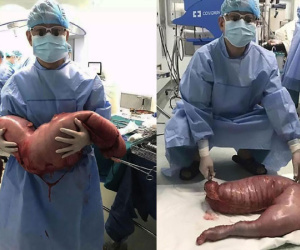 Mổ bụng bệnh nhân, bác sĩ tá hỏa khi phát hiện khối đại tràng dài 76cm do bị táo bón nhiều năm