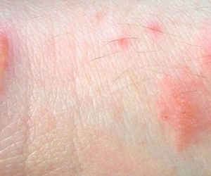 Phát ban sinh dục: Có chữa khỏi được không?