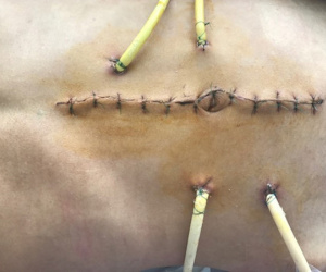 Cứu sống bệnh nhân bị cọc nhồi bê tông ép vỡ tá tràng