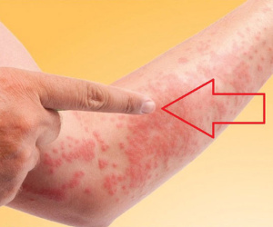 Tiêu chí đánh giá cơ thể nhiễm độc nặng hay nhẹ: Xem xong bạn sẽ biết mình cần phải làm gì