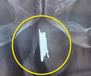 Bác sĩ toát mồ hôi khi mổ gắp 15 cây kim cho quý ông thích "tự sướng"