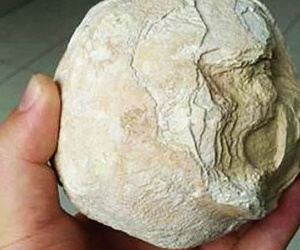 Đi tiểu ra máu, người phụ nữ mới đi khám và phát hiện ra "quái vật" này trong bụng