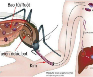 Cách phân biệt sốt xuất huyết, sốt phát ban