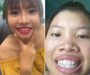 Phượng "Thị Nở" khoe răng cũ để PR răng mới nhờ chi tiền "khủng"?