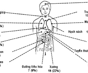 Thủ phạm gây ung thư amidan bạn cần tránh