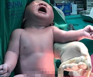 Sản phụ sinh bé trai mang vòng dây rốn thắt nút hiếm gặp