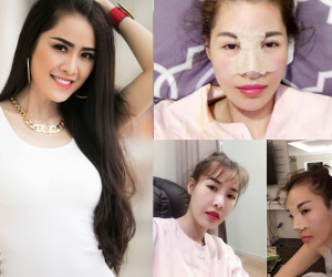 Quế Vân chi 400 triệu để sửa mặt lần hai