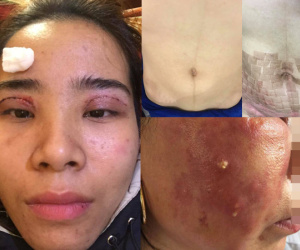 Chi 15 triệu làm đẹp sau sinh ở spa, mẹ trẻ bị bắn laser chín thịt, bụng chi chít sẹo bỏng