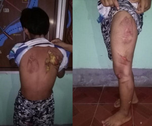 Cô bé 13 tuổi đi làm giúp việc bị chủ nhà dùng bàn là nóng bạo hành rồi đổ nước sôi lên người