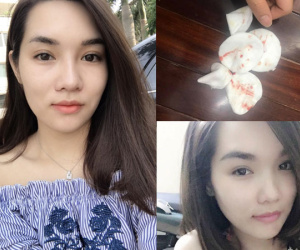 Ham làm đẹp bằng phương pháp tiêm filler, cô gái trẻ bị vẹo mũi, bóp ra đầy dịch vàng vón cục lẫn máu