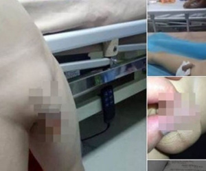 Hưng Yên: Cho con đi cắt bao quy đầu, mắc bệnh sùi mào gà