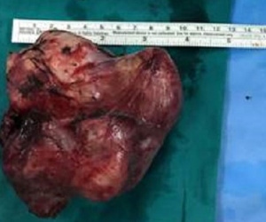 TP.HCM: 3 tiếng cắt trọn khối u quái khổng lồ cứu sống bé trai 2 tuổi