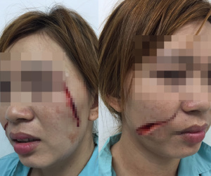 Từ chối tình yêu, cô gái bị chém hai nhát vào mặt