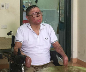 Chiến sĩ sống sót vụ rơi máy bay ở Hòa Lạc: "Có người nhận tài trợ lắp tay giả cho tôi"