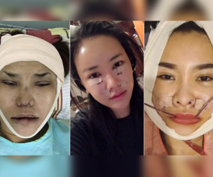 Nhìn loạt ảnh trong và sau quá trình 'dao kéo' mới thấy mỹ nhân Việt chịu đau giỏi như thế nào