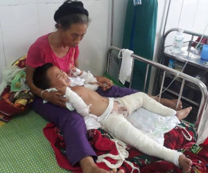 Nghịch xăng, bé 4 tuổi cháy xém từ bụng đến chân