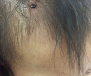 Qua nhà bạn hàng xóm chơi, bé gái 19 tháng tuổi bị cây đinh bén ghim vào đầu