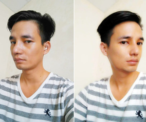 Lệ Rơi tháo băng mũi, lộ diện hình ảnh đẹp như soái ca