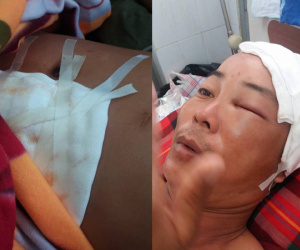 Đắk Lắk: Hai công an xã xô xát, một người bị chấn thương sọ não