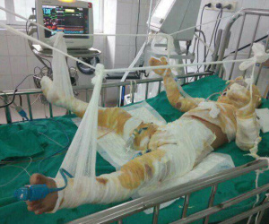 Xót xa hoàn cảnh bé trai sang hàng xóm xem nướng mực bị cồn thiêu như đuốc, hoại tử 2 chân