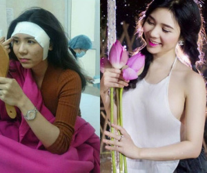 Thanh Bi lên tiếng về loạt ảnh phẫu thuật thẩm mỹ cận cảnh
