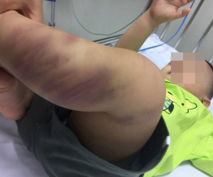 Hà Nội: Cảnh sát vào cuộc vụ bé trai 1 tuổi nghi bị bạo hành nghiêm trọng