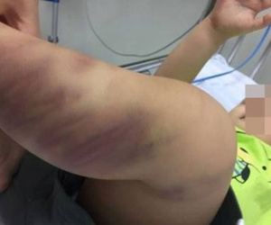 Bé trai một tuổi nghi bị bạo hành bơ vơ ở viện đang nguy kịch