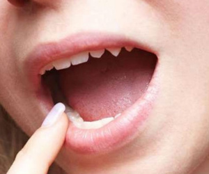 Ung thư vòm họng vì mắc sùi mào gà ở miệng