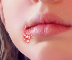 4 căn bệnh lây nhiễm qua đường tình dục bạn không ngờ tới