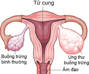 6 dấu hiệu lạ của cơ thể báo hiệu bạn có thể bị ung thư buồng trứng