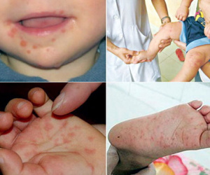 Sốt xuất huyết chưa qua, lo thêm tay chân miệng
