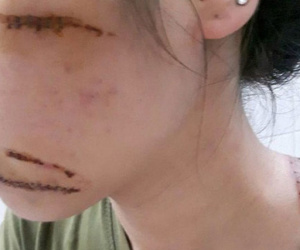 Nhân viên spa bị nhóm côn đồ lao vào chém phải khâu 21 mũi