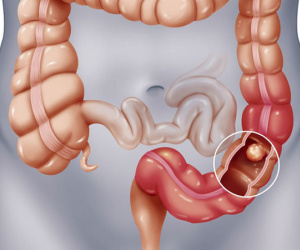 Ăn uống vô độ khiến đường ruột nhiễm độc: Hãy uống cốc nước này 1 lần/tháng để phòng bệnh