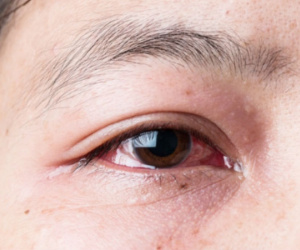 Dịch đau mắt đỏ rục rịch vào mùa