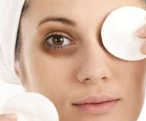 10 cách trị quầng thâm mắt bằng nguyên liệu tự nhiên
