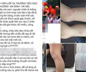 Cô giáo đánh học sinh bầm tím chân bị kỷ luật cảnh cáo