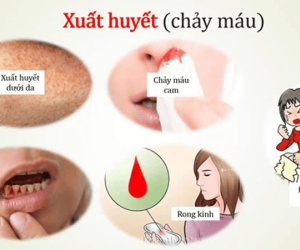 Sốt xuất huyết có lây qua đường tình dục không?