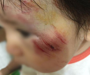 Hà Nội: Truy tìm nam thanh niên phóng mô tô tông bé gái 11 tháng trầy xước mặt rồi bỏ chạy
