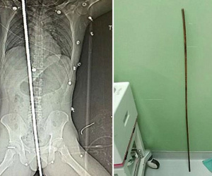 Công nhân xây dựng bị sét đánh, thanh thép dài 2m đâm xuyên người vẫn sống sót kỳ diệu