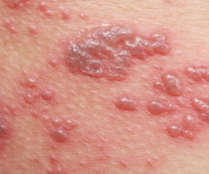 7 nguyên nhân dẫn đến bệnh Lichen phẳng - Căn bệnh viêm da không có cách điều trị