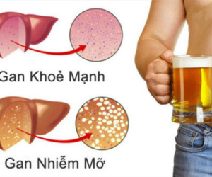Sức khoẻ gan rất quan trọng: 6 dấu hiệu bệnh gan nhiễm mỡ bạn cần biết để phát hiện ngay