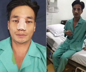 Chán mũi nhân tạo, Lệ Rơi lại sửa để tìm về diện mạo ban đầu