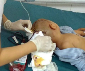 Công an điều tra vụ bé trai tụ máu não do ngã ở trường mầm non