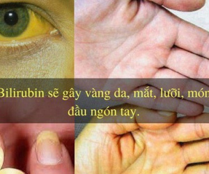 34 tuổi đã xơ gan giai đoạn cuối: Bác sĩ chỉ tận mặt thủ phạm gây ra 70% trường hợp xơ gan